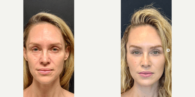 Neck Lift