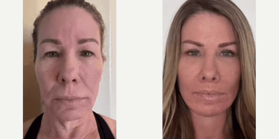 Eyelid Surgery