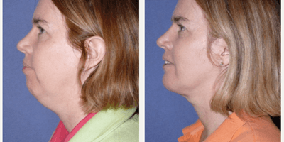 Liposuction