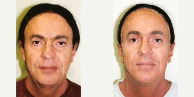 Facelift