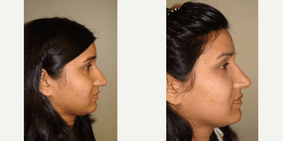 Rhinoplasty