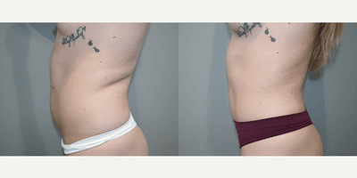 Liposuction