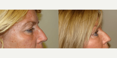 Brow Lift