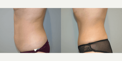 Tummy Tuck