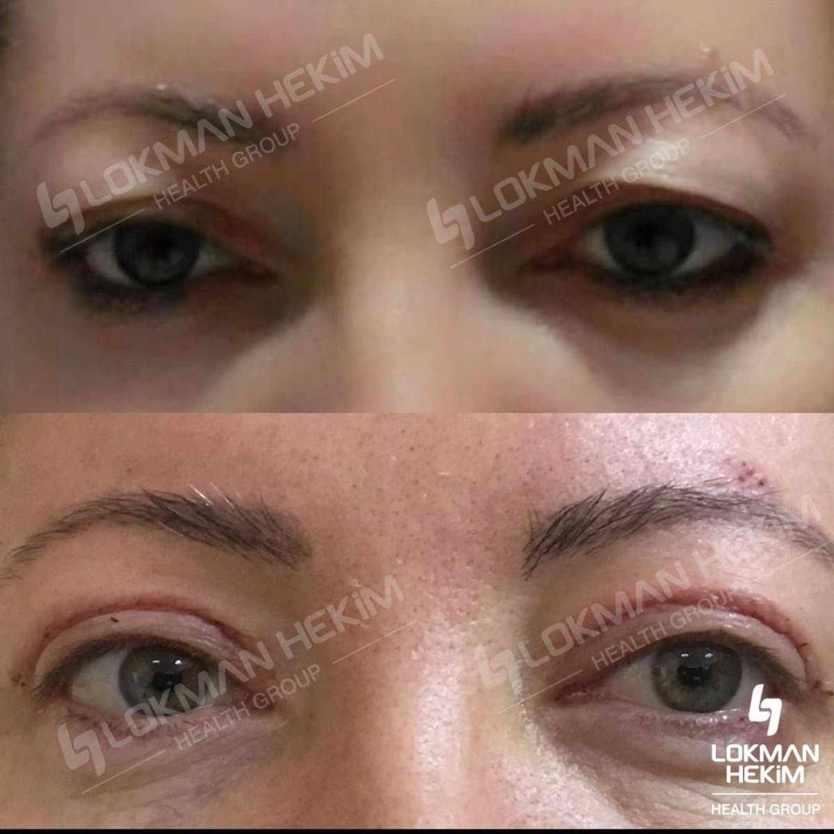 blepharoplasty
