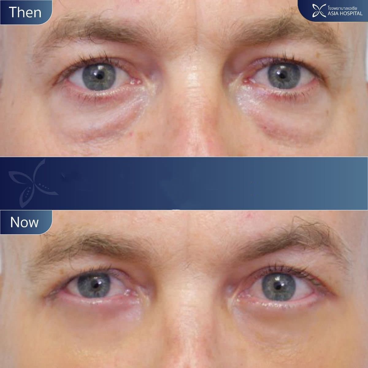 upper eyelid surgery