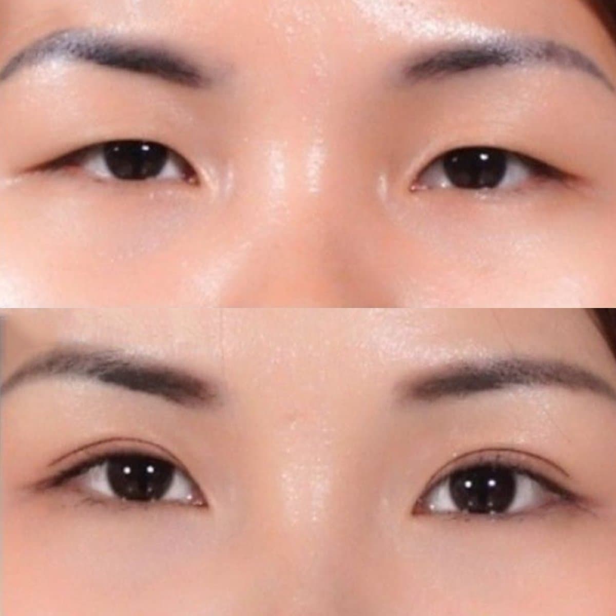 upper eyelid surgery