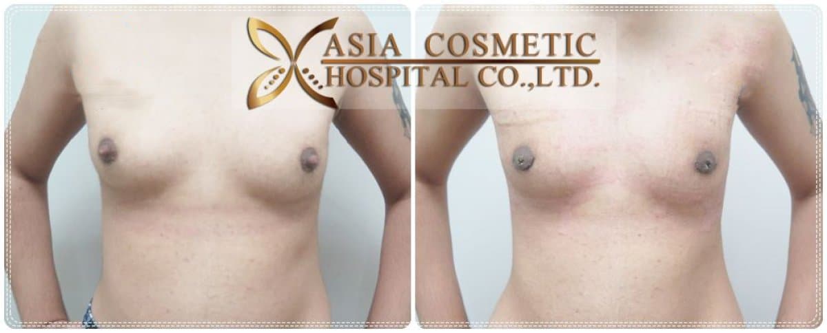 top surgery