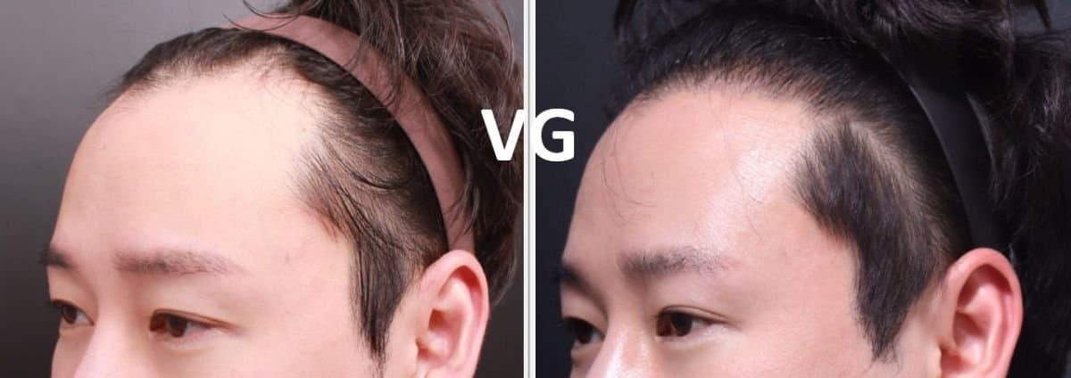 FUE hair transplant