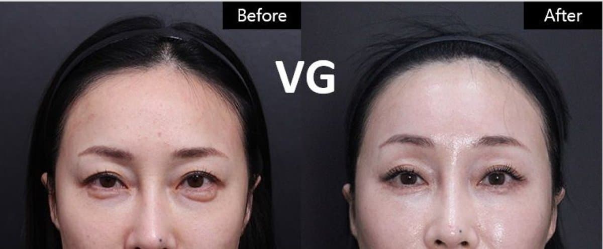 droopy eyelid surgery