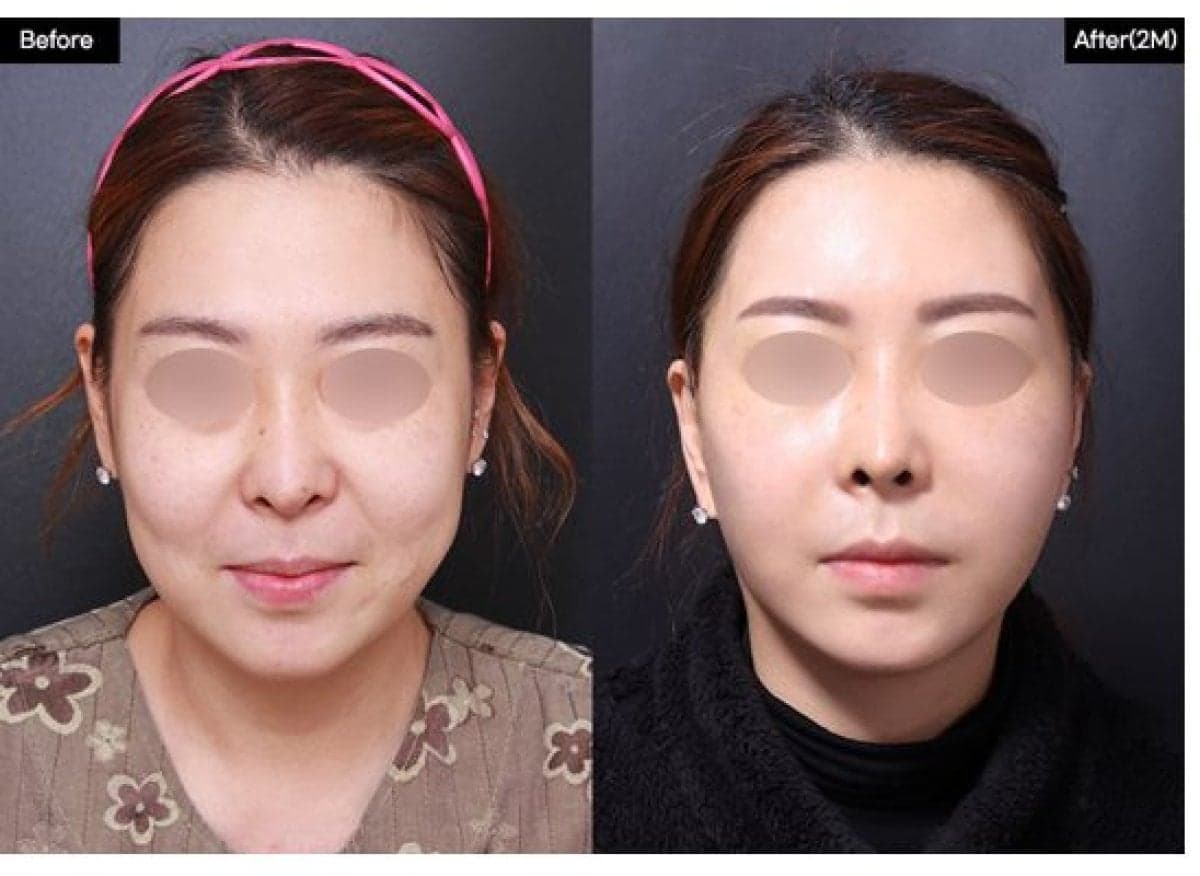 buccal fat extraction