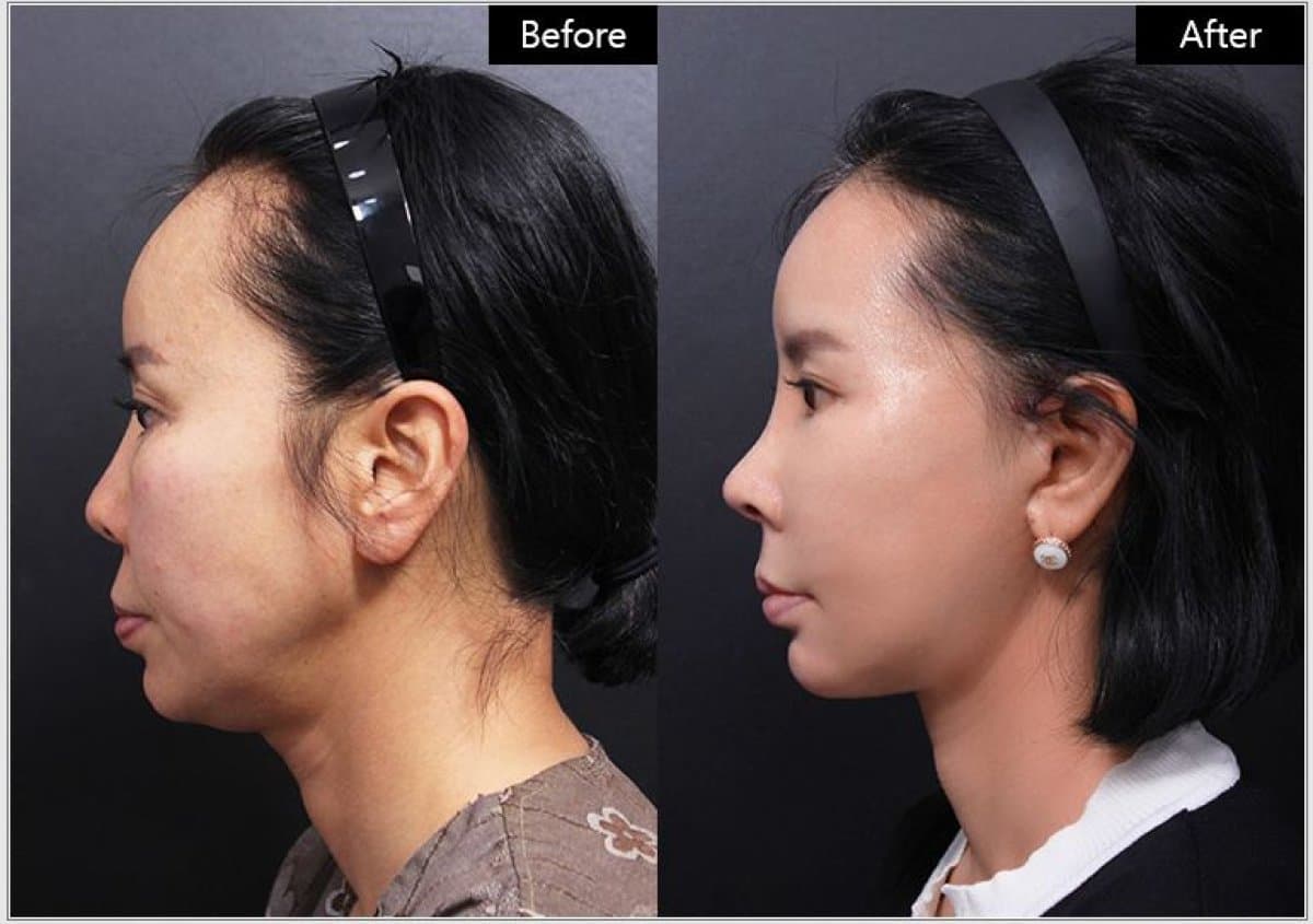 nonsurgical facelift