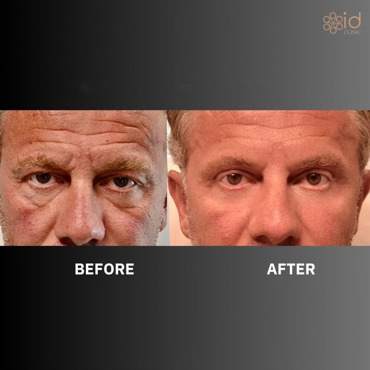 liposuction for gynecomastia