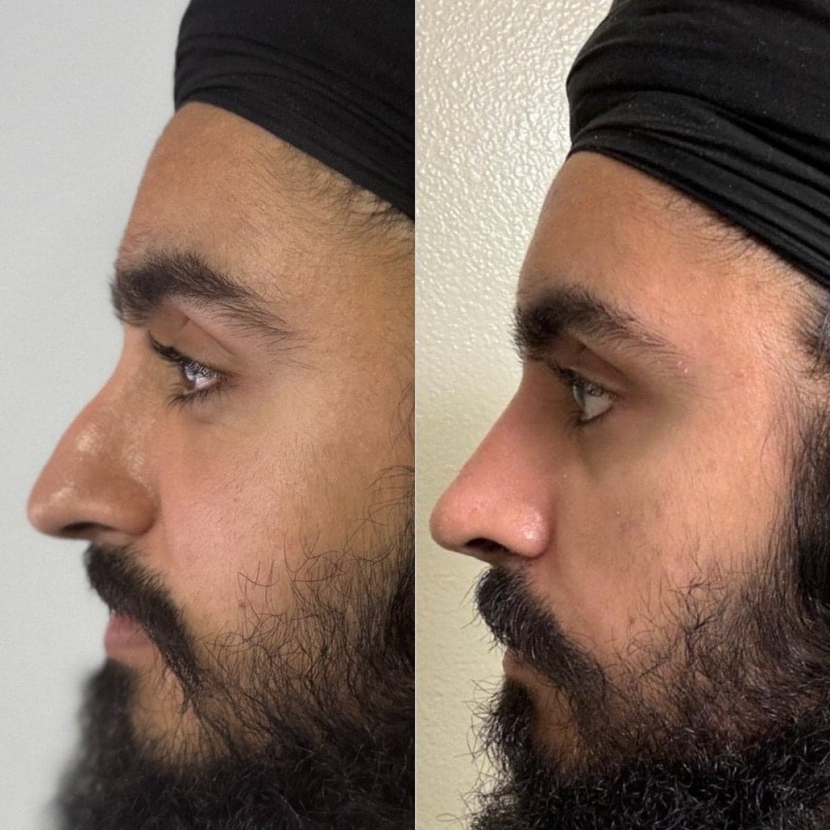 rhinoplasty