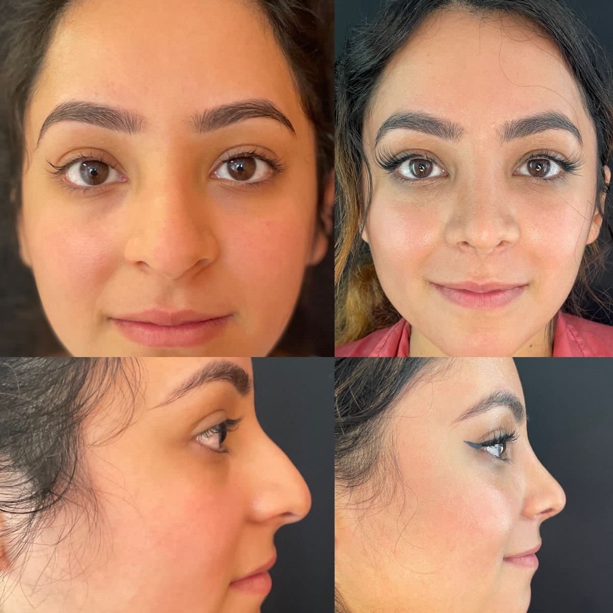 ultrasonic rhinoplasty