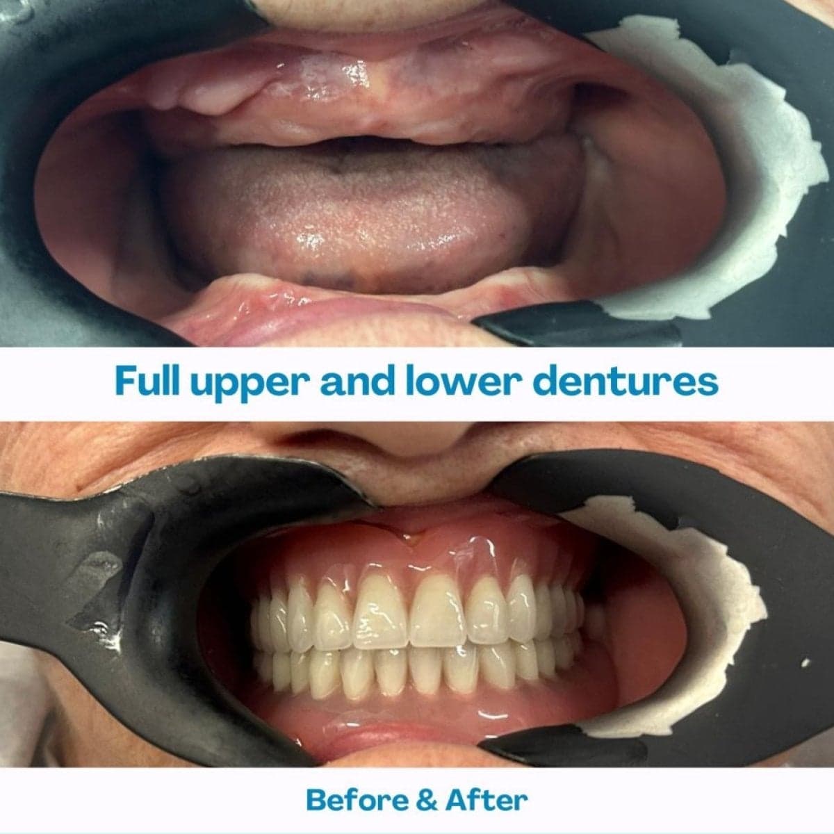 full dentures installation