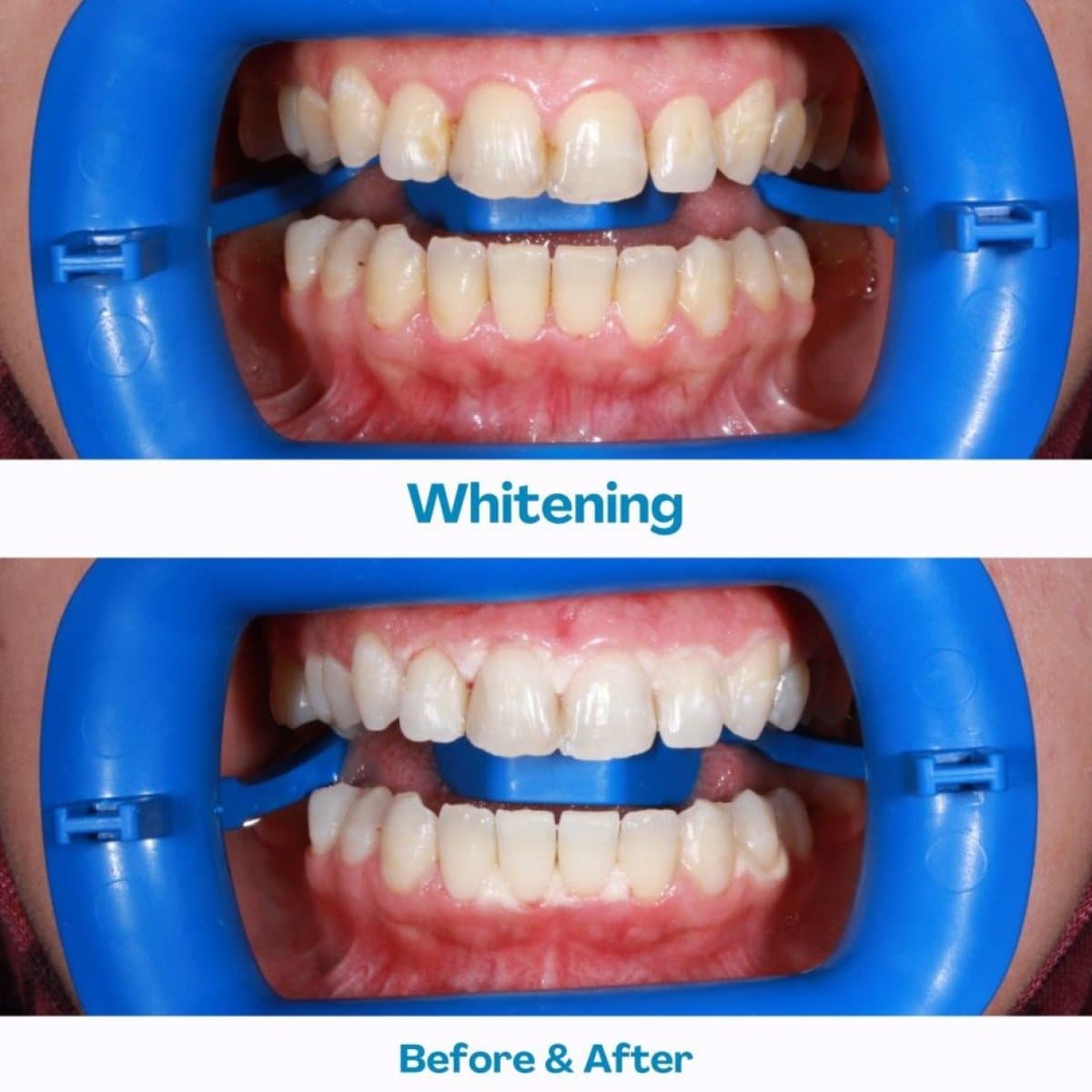 laser teeth whitening