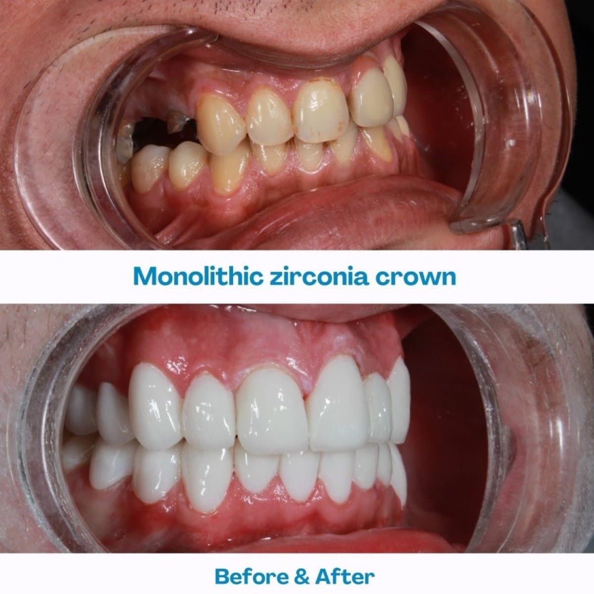 zirconia crown