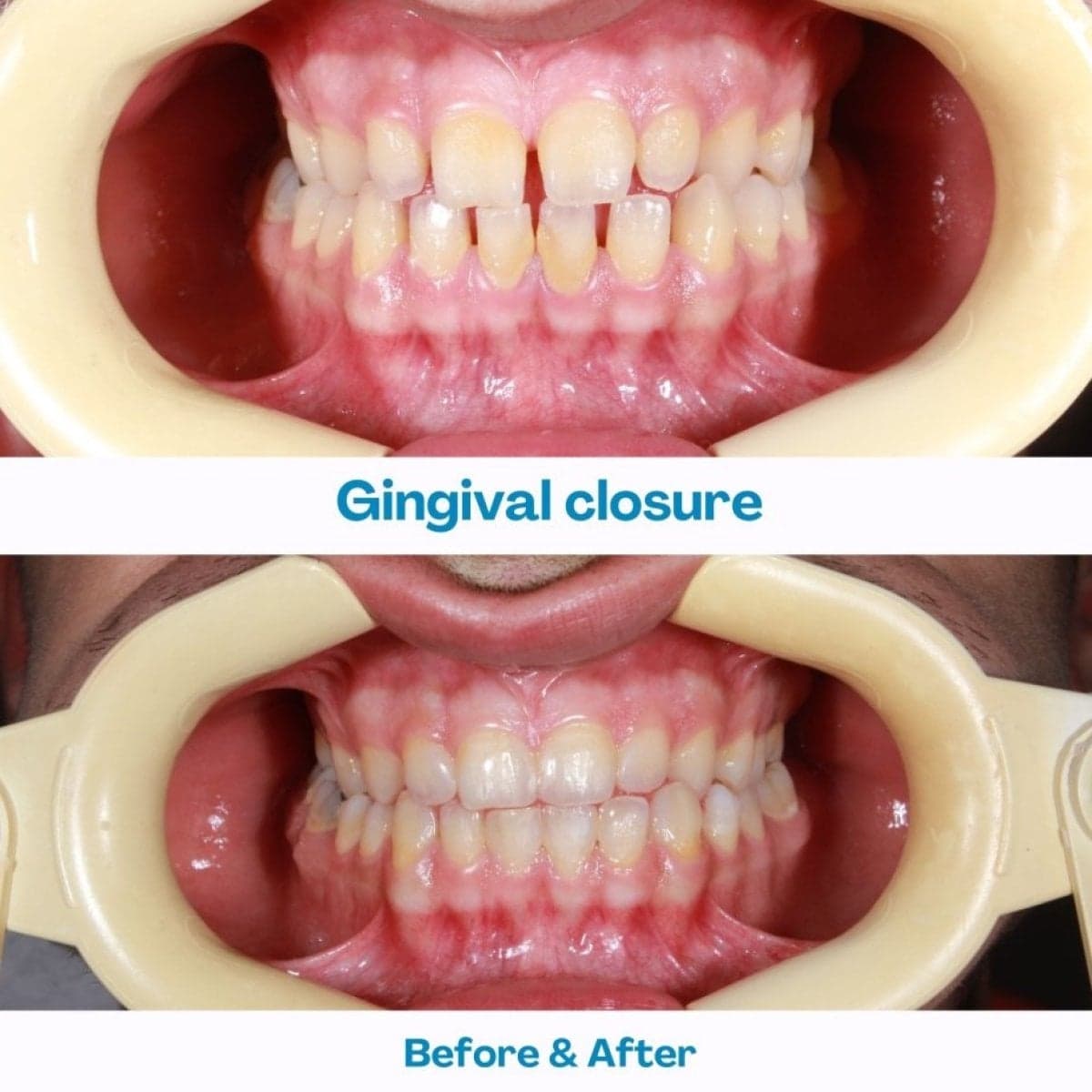 gingivectomy