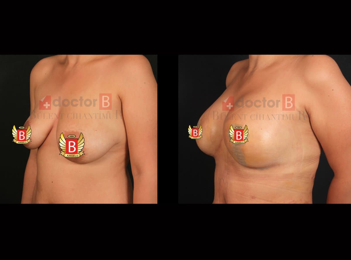 breast implants with lift
