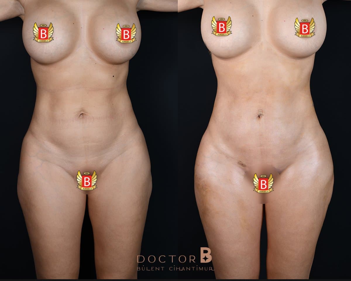 tummy tuck and liposuction
