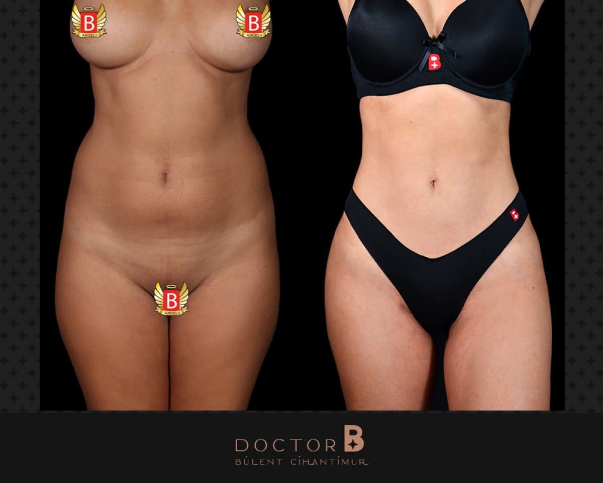 tummy tuck and liposuction
