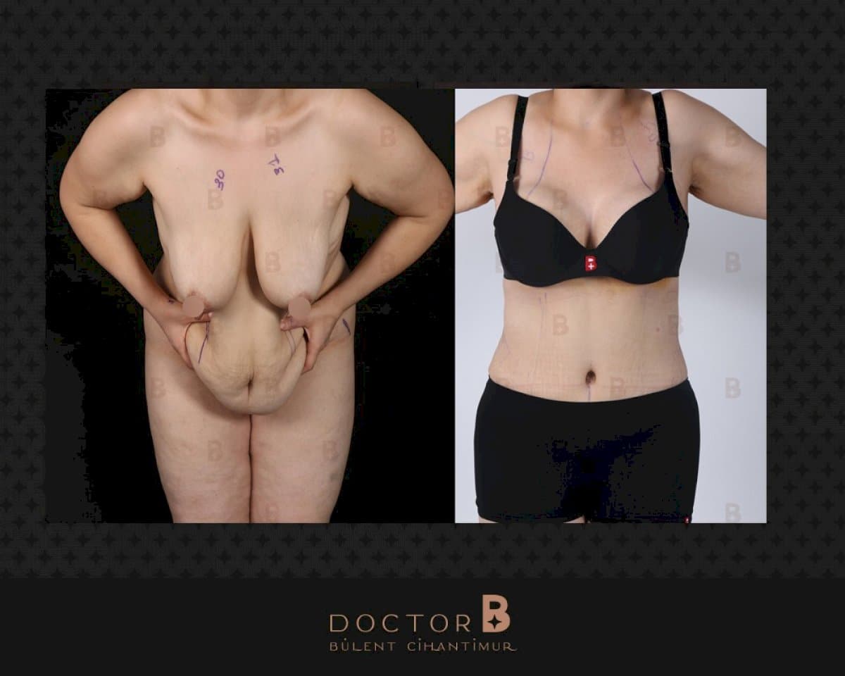 tummy tuck