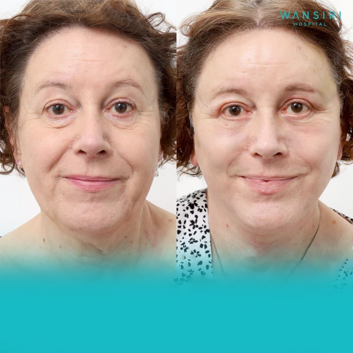 fillers injection