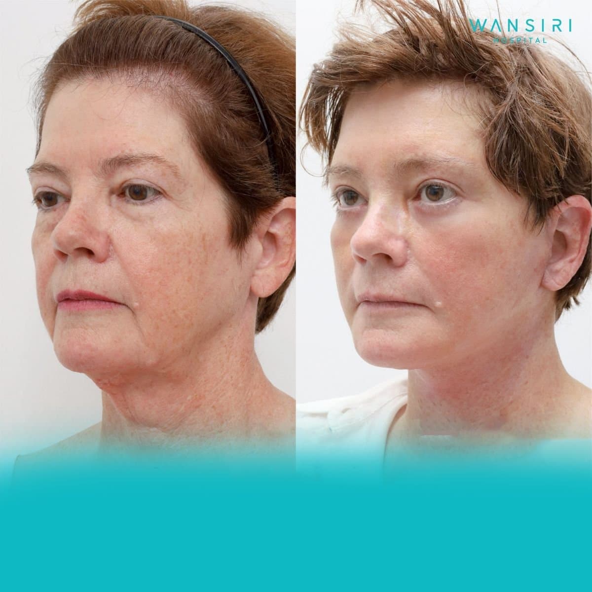 facelift