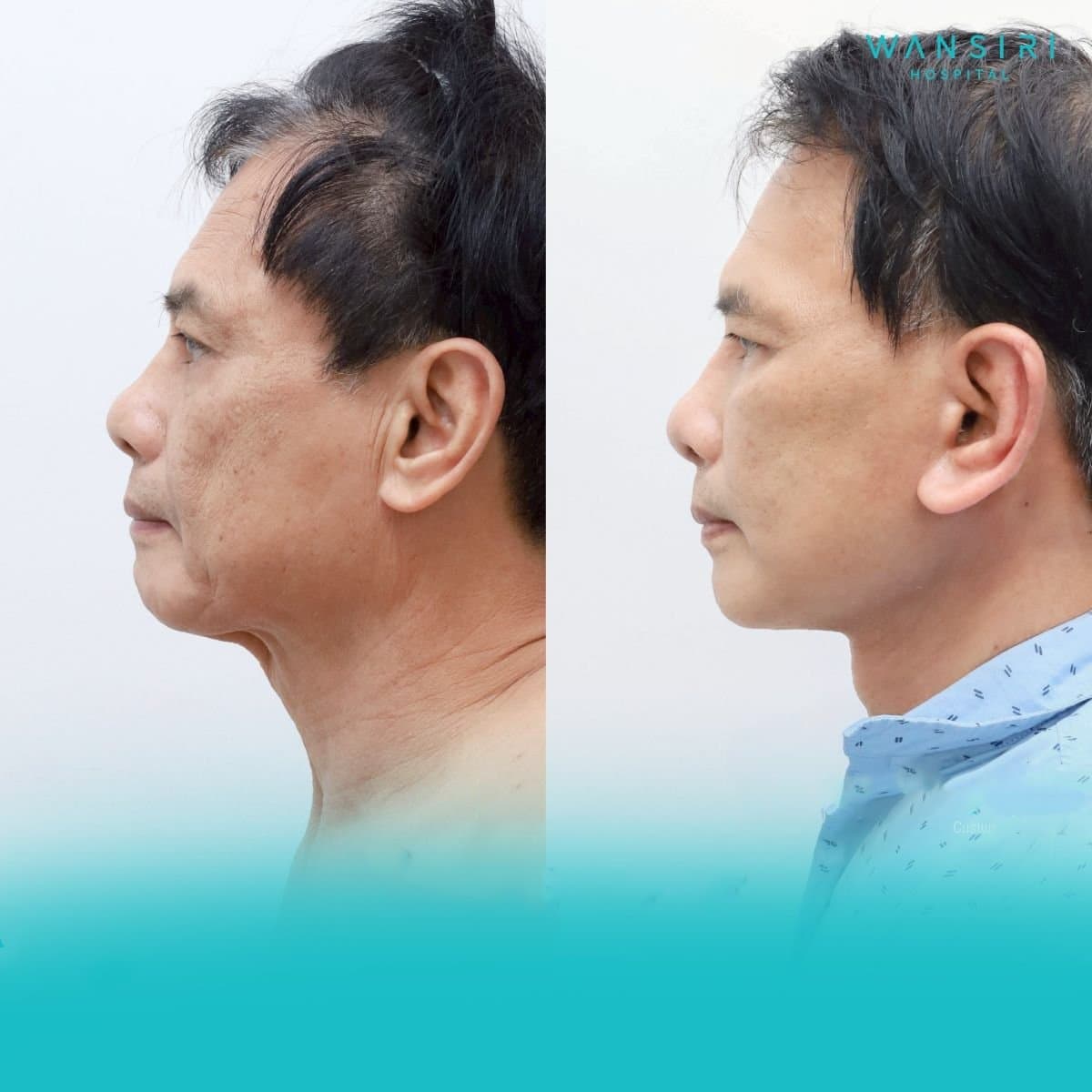 facelift