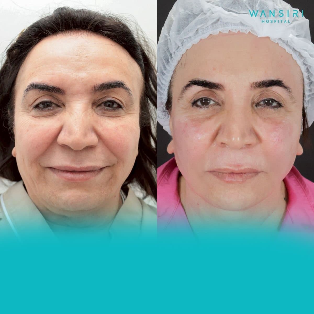 facelift