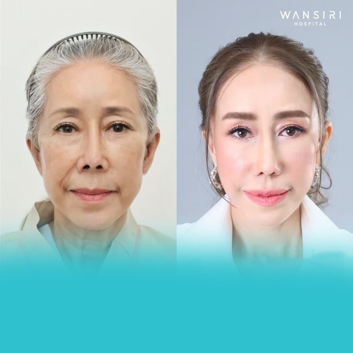fillers injection