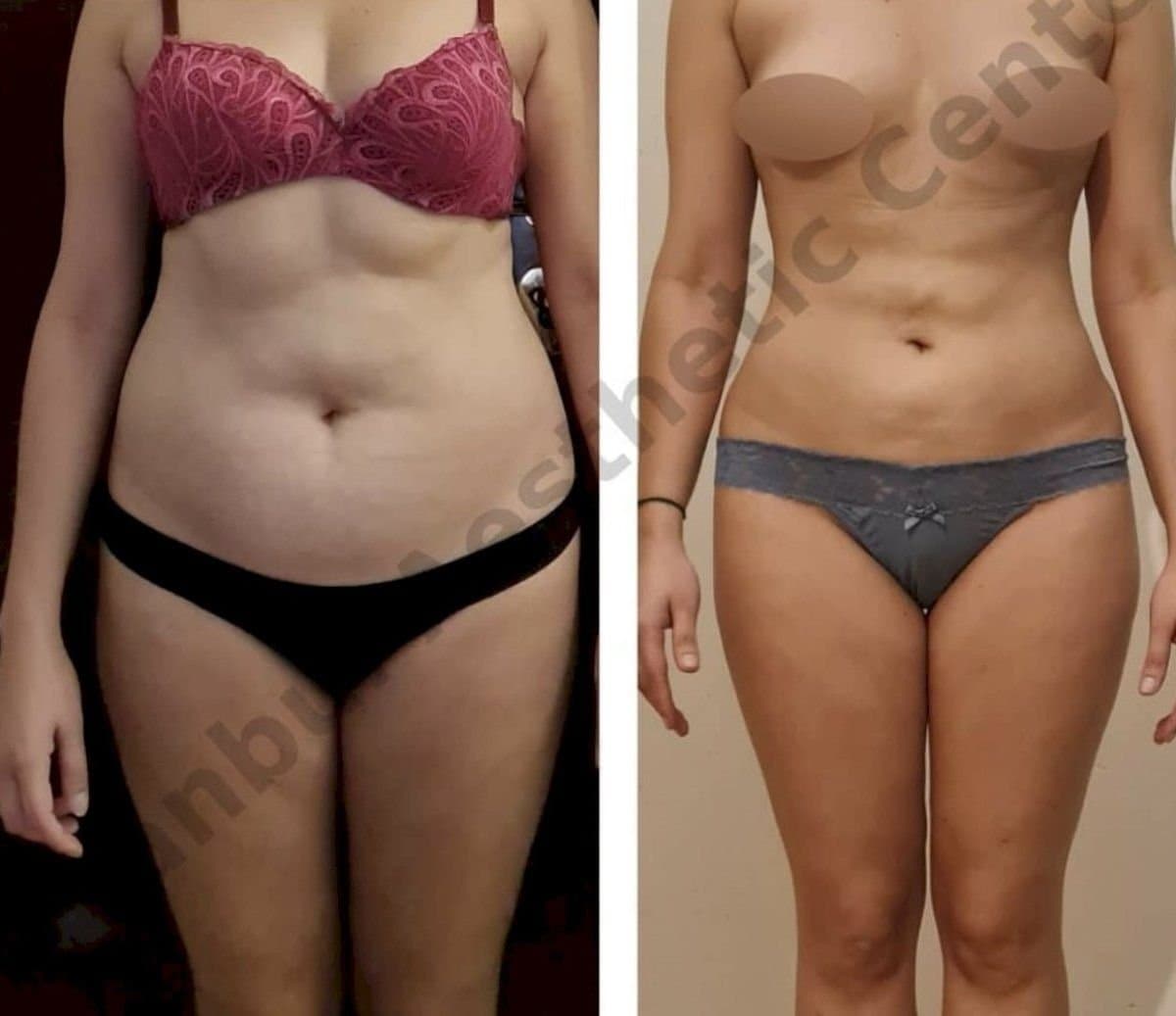 liposuction 3 body areas