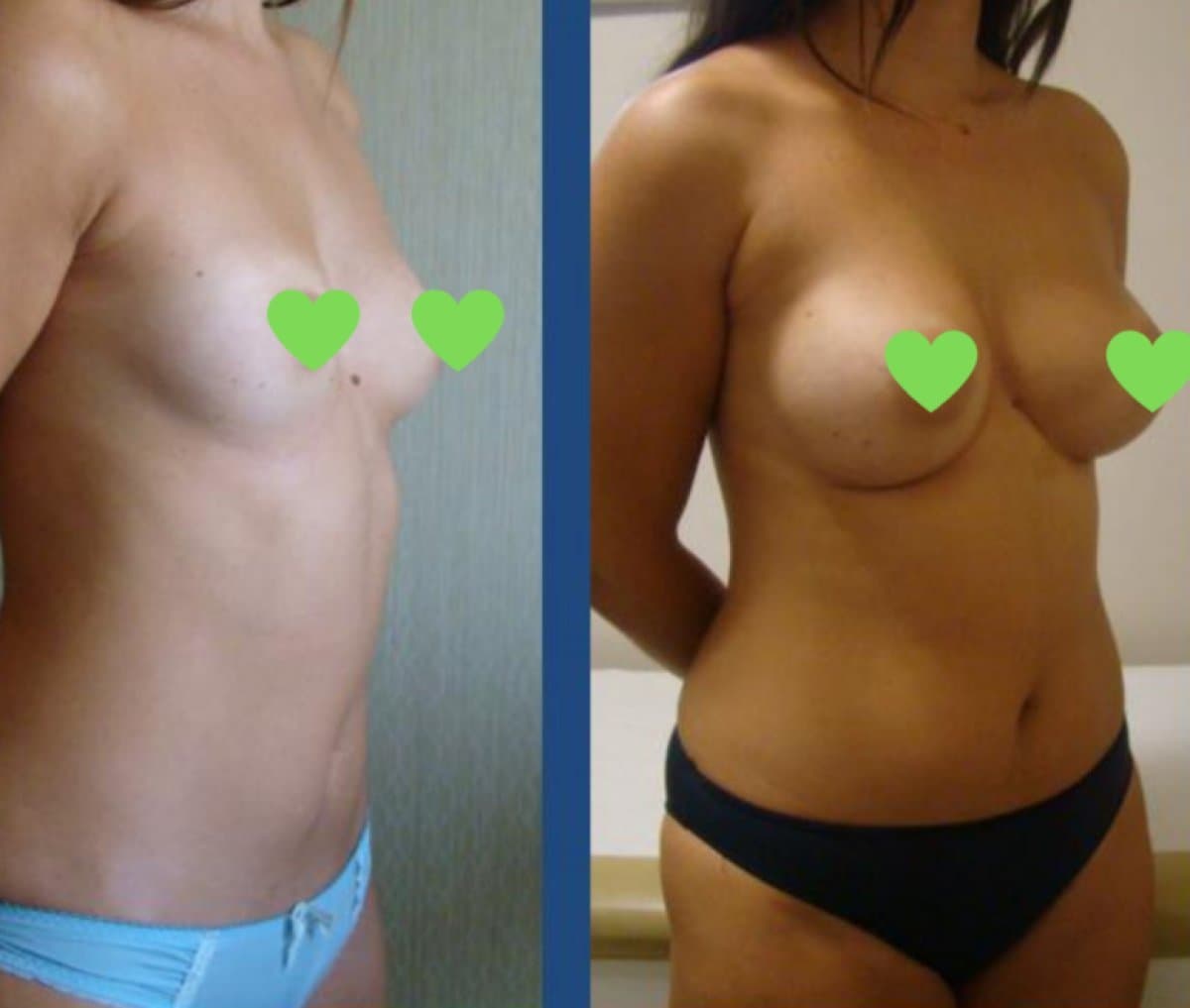 mammoplasty