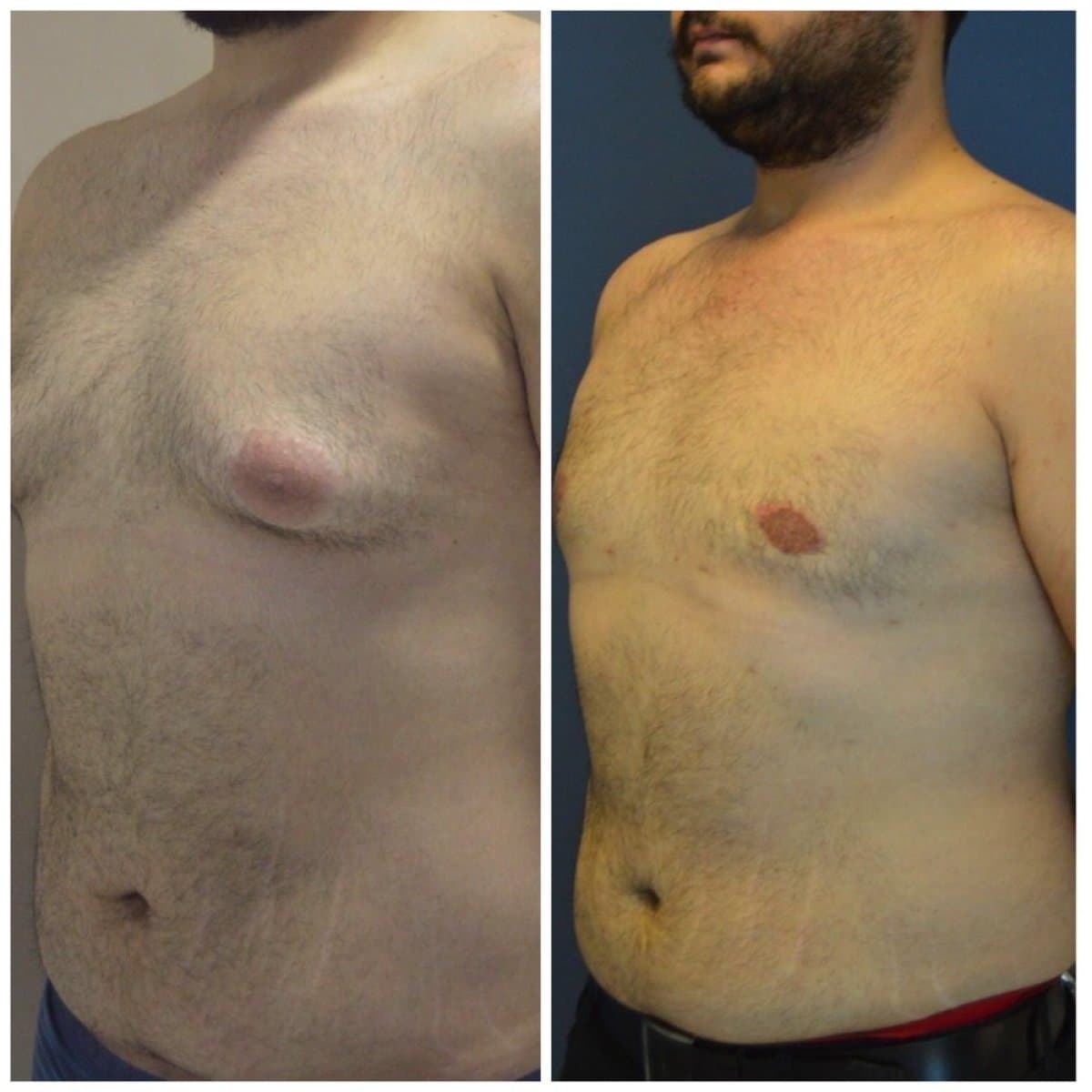 gynecomastia surgery