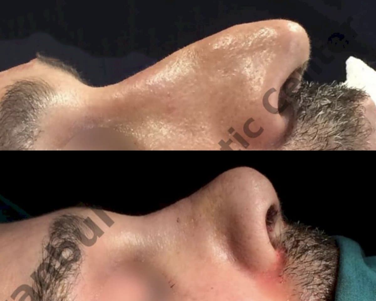 rhinoplasty