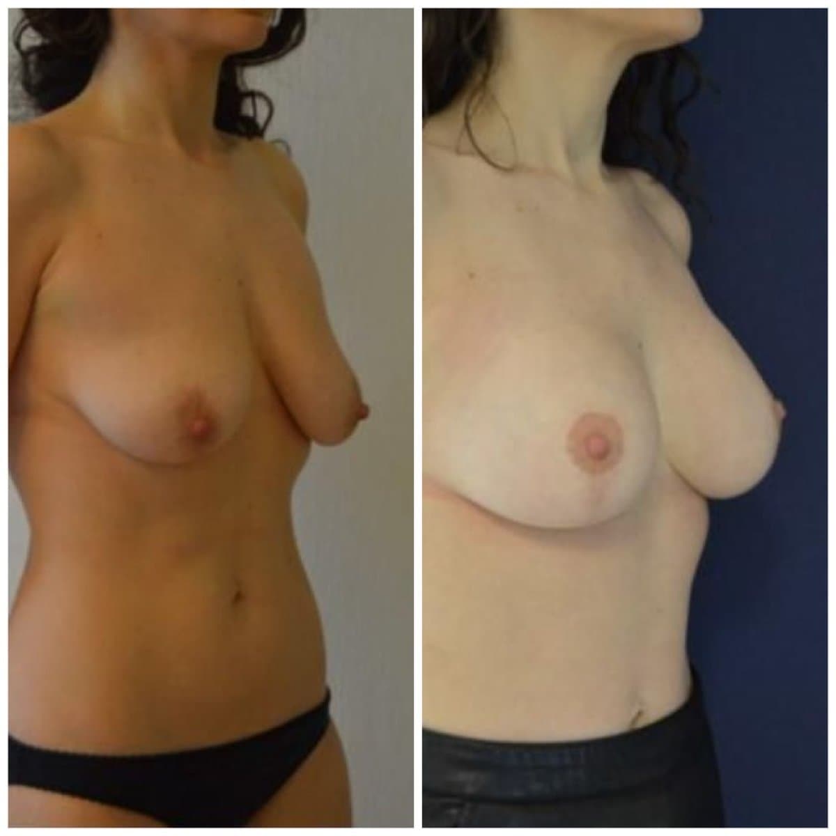 mammoplasty