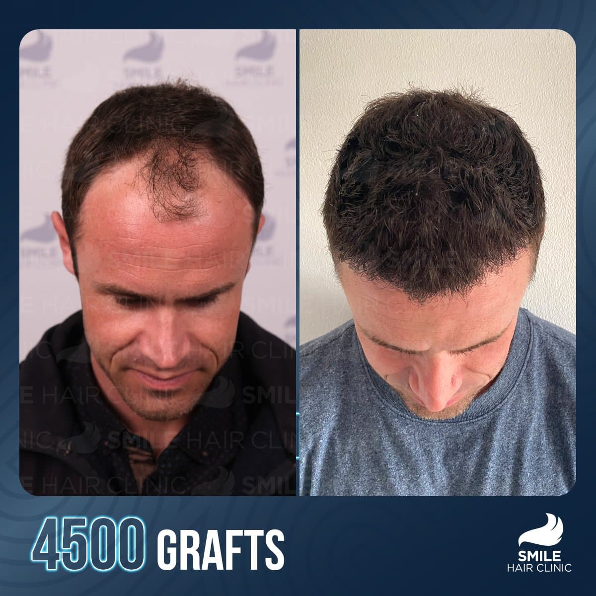 FUE hair transplant