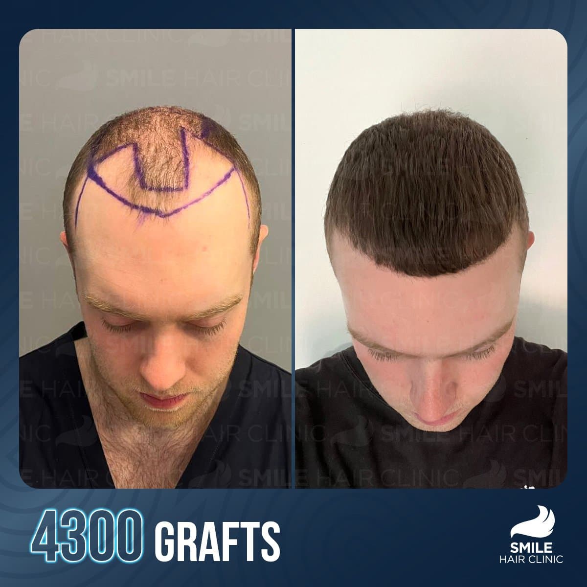 result with 4300 grafts