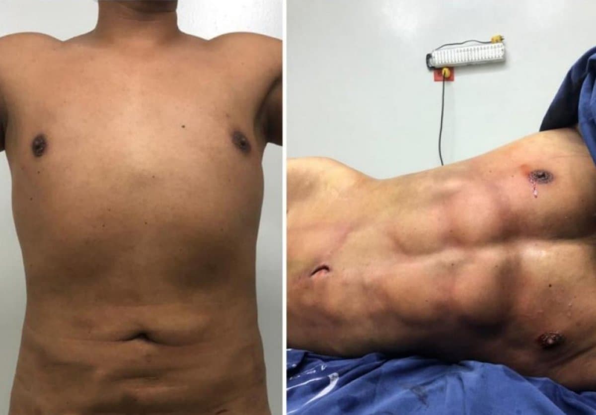 abdominal etching