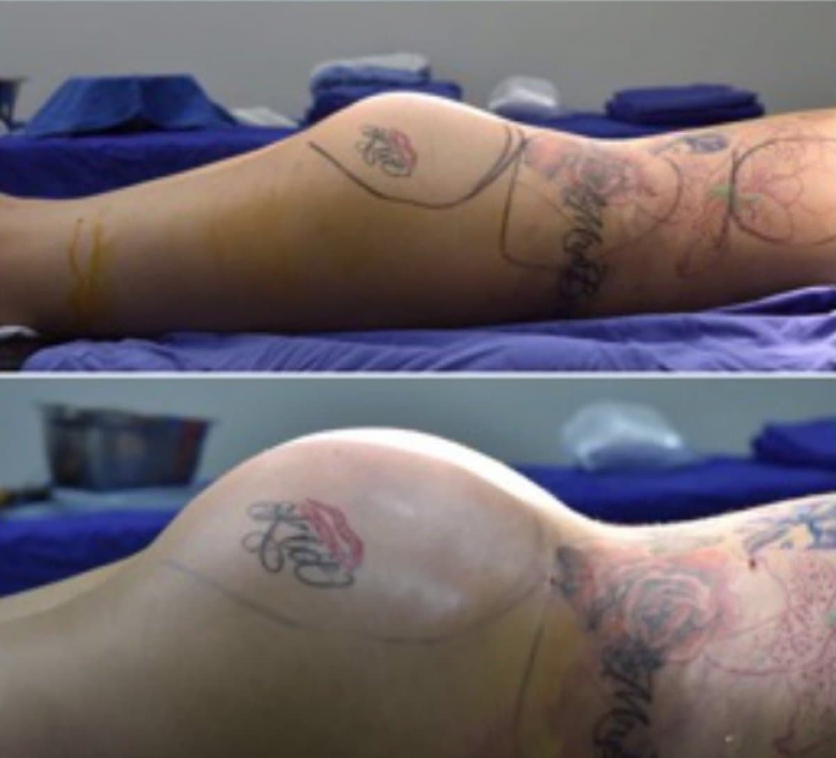 Brazilian Butt Lift