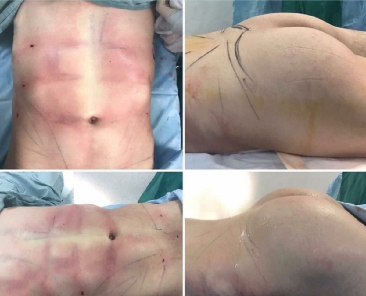 tummy tuck