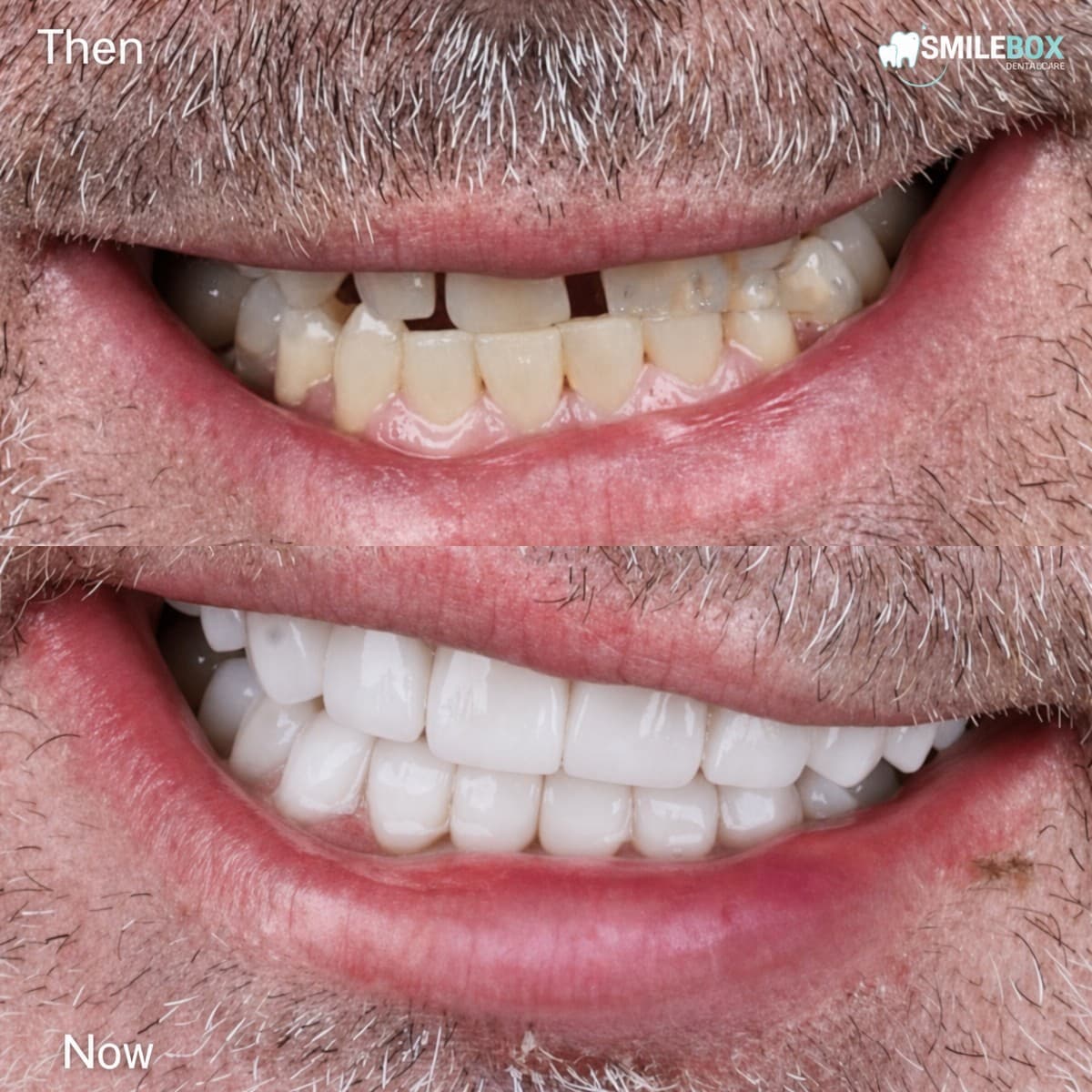 denture