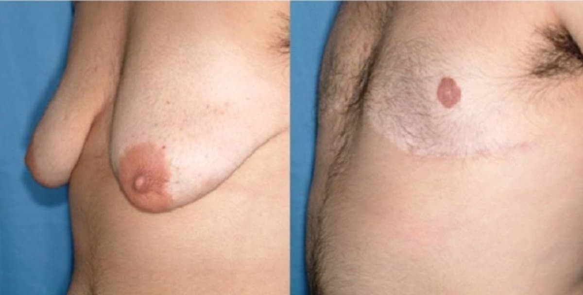 top surgery