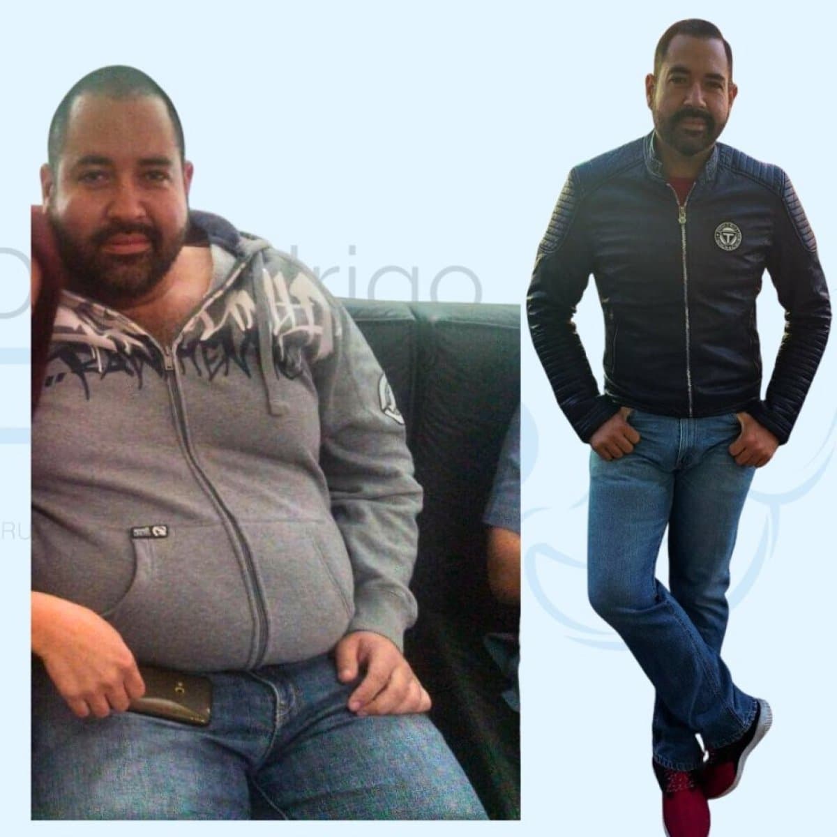 gastric bypass