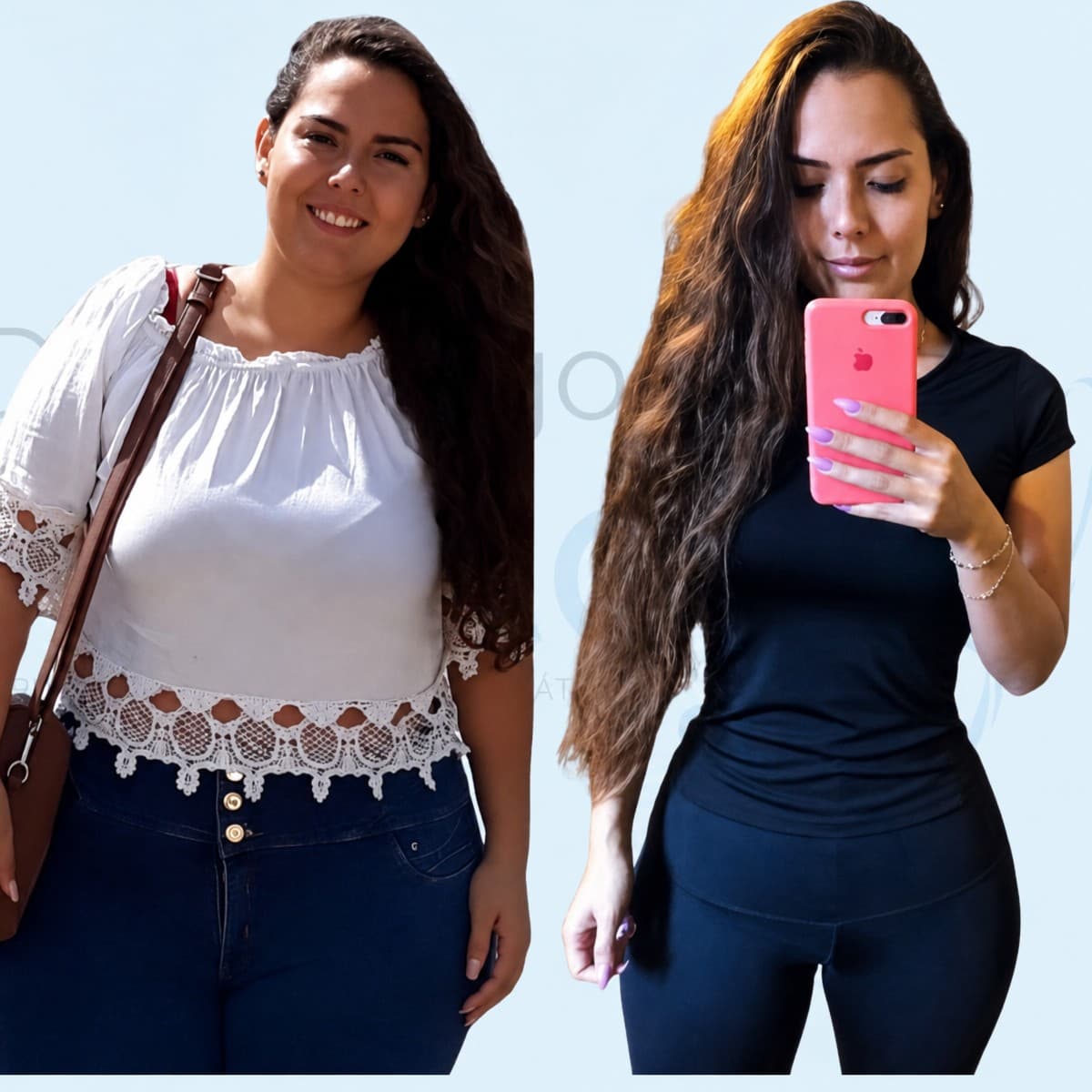 gastric sleeve surgery