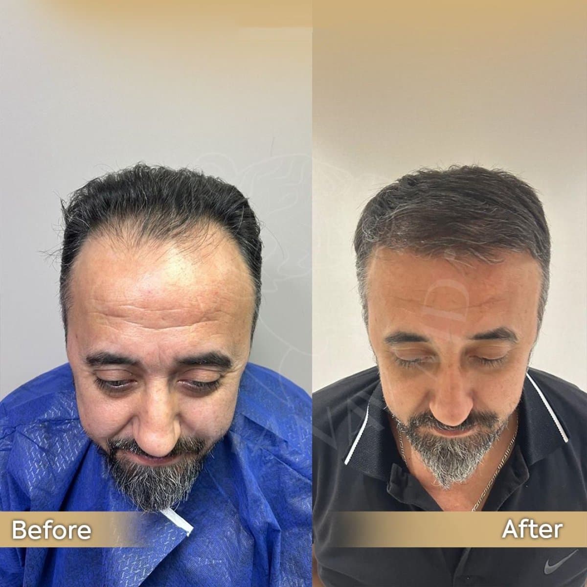 Deep Plane Facelift