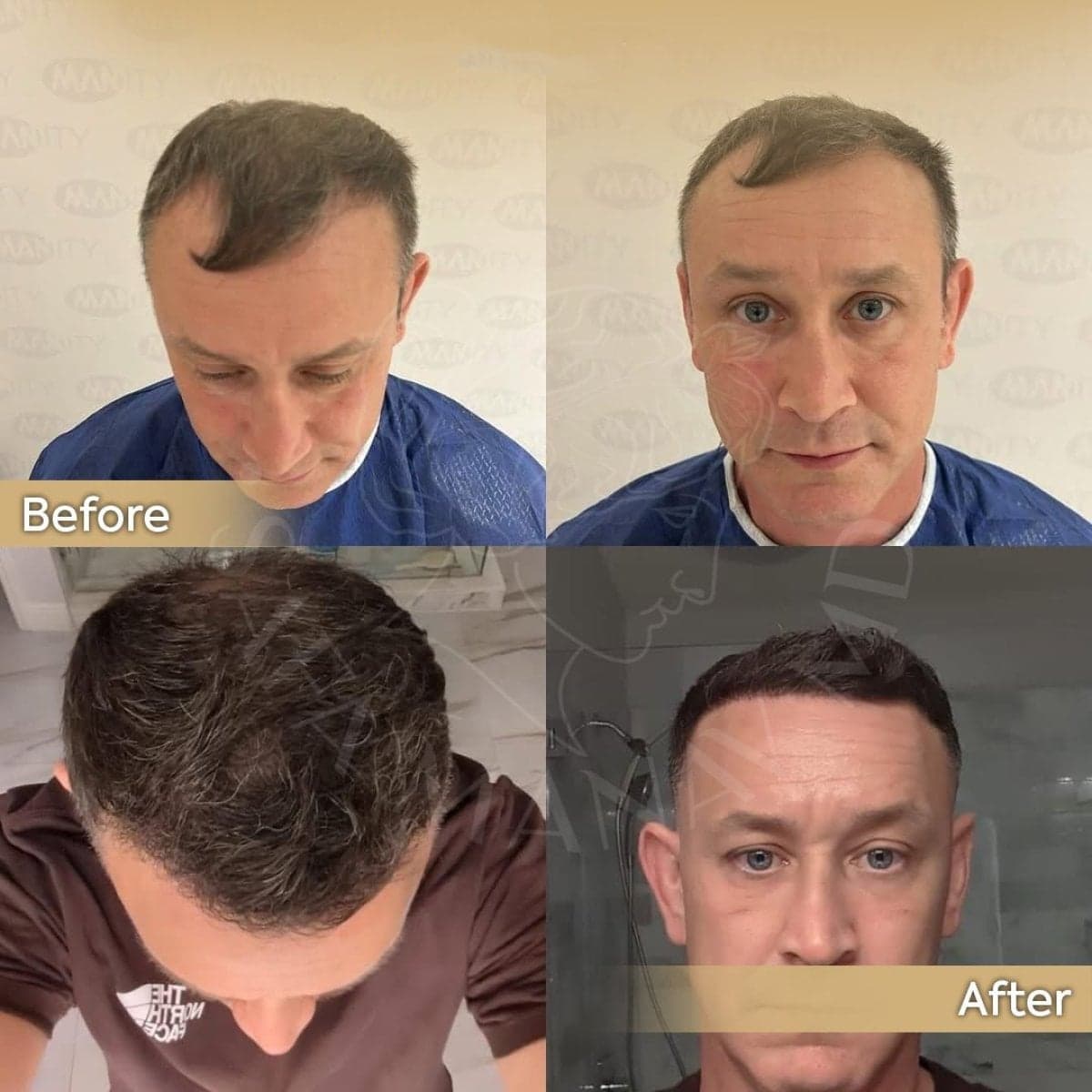 breast implant revision