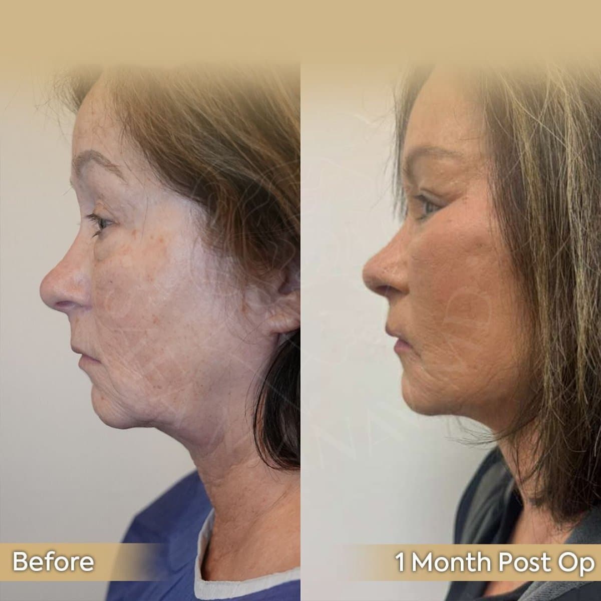 breast lift