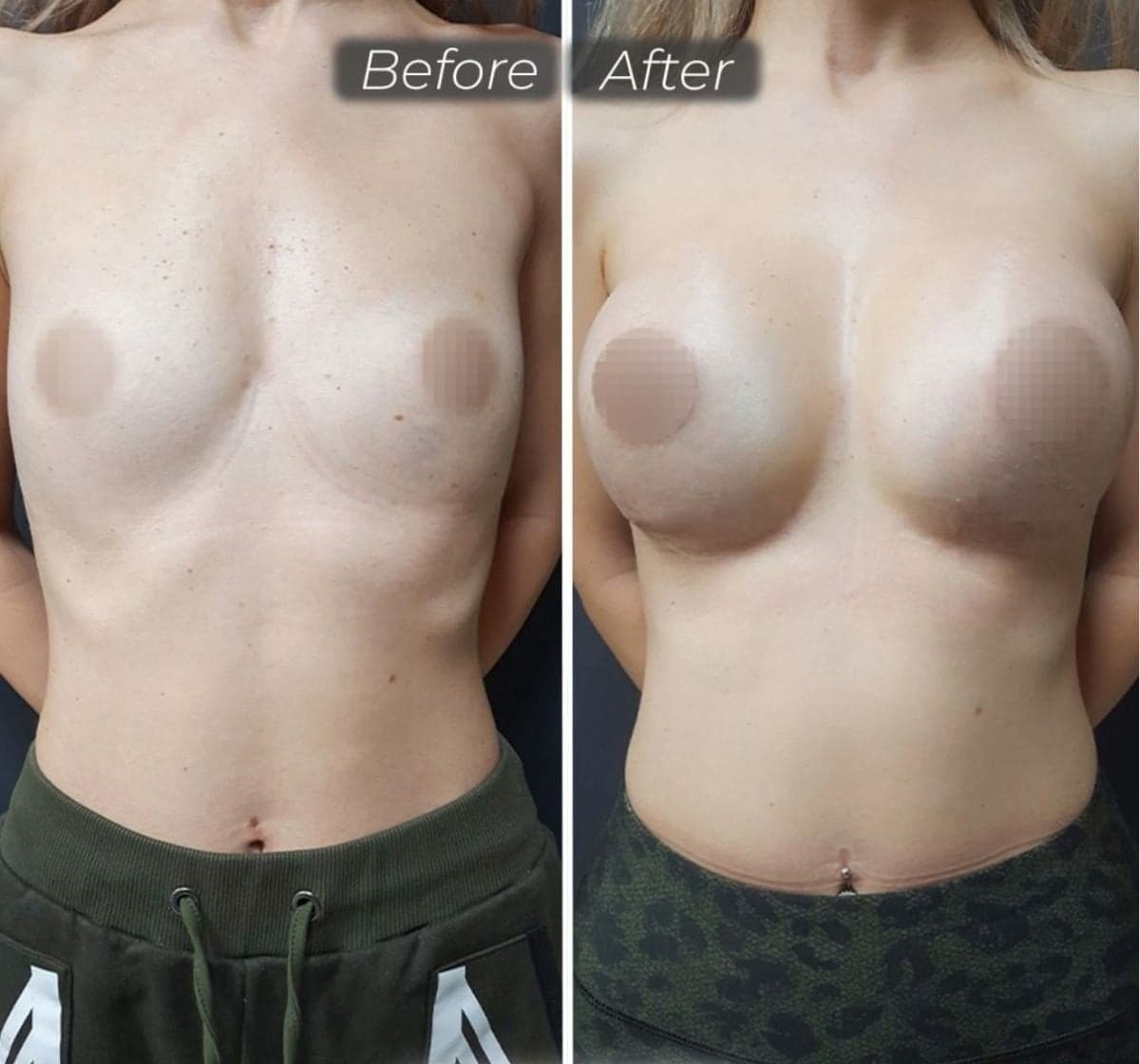 breast implant removal